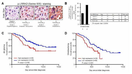 뇌종양 환자에서의 LRRK2 인산화 발현 분포 조사를 위해 228명의 뇌종양 환자조직에서 Immunohistochemistry를 통해 확인 (A). 염색결과 약 40%의 환자는 2+ 이상으로 매우 높은 LRRK2 인산화 발현이 확인함 (B). 특히 LRRK2의 인산화 발현이 높은 All glioma (C) 와 Glioblastoma (D) 환자 모두에서 예후가 좋지 않음을 확인함