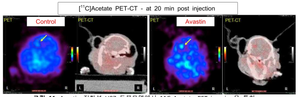 Avastin 저항성 U87 동물모델에서 11C-Acetate PET imaging을 통한 종양 내 acetate 활용 평가