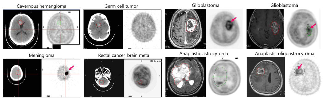 다양한 뇌종양에서 11C-Acetate PET imaging을 통한 암조직의 Acetate 활용여부 확인