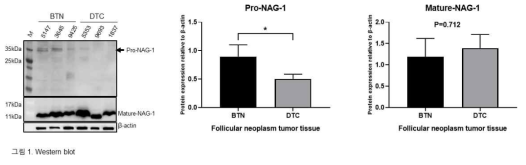 BTN, DTC 각 세 명의 환자의 종양 조직에서 추출한 단백질을 사용하여 western blot을 진행하였다. NAG-1을 pro와 mature 두 가지 form으로 detection하였으며 이를 각각 그래프로 나타내었다