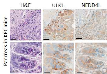KPC마우스의 췌장에서 PDAC병변부위의 ULK1과 NEDD4L 발현분석