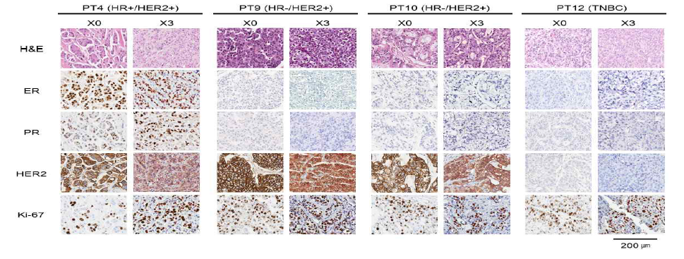 환자 종양과 PDX 모델 종양에서 병리학적 특성 비교