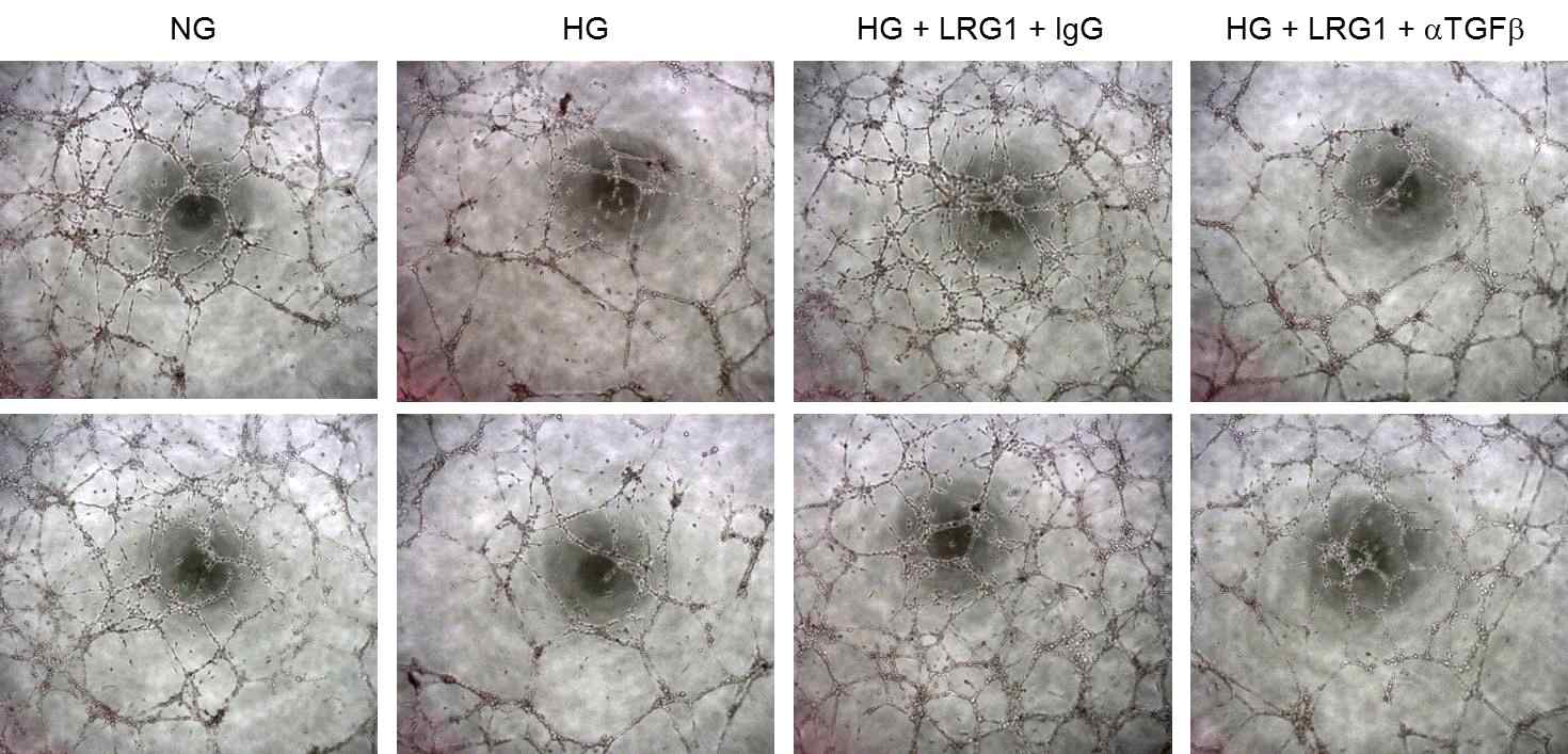 Inhibition of TGFb signaling blocks LRG1-mediated tube formation in mouse cavernous endothelial cells (MCECs). (마우스 음경혈관내피세포를 이용한 실험에서 고 글루코오즈 조건에서 LRG1 단백질에 의해 촉진된 튜브형성이 TGFb 신호전달 억제제 [aTGFb]에 의해 다시 억제됨)