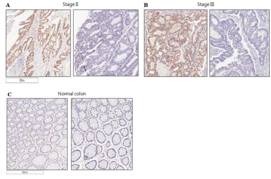 대장암 및 정상조직에서 KSRP의 면역염색