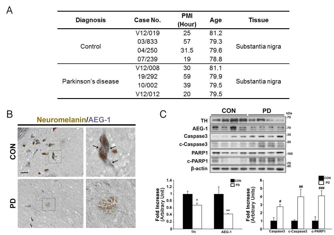 추가 확보한 파킨슨병 환자와 정상 대조군의 사후 뇌조직에서 AEG-1 발현 및 세포사멸 관련 인자의 발현 변화 확인. (A) 파킨슨병 환자 사후 기증된 뇌조직 정보. (B) 파킨슨병 환자 흑질 내 도파민 신경세포(Brown: Neuromelanin)에서 AEG-1 (Blue)신호 감소 확인 (scale bar, 50㎛). (C) 파킨슨병 환자 사후 뇌조직 유래 시료에서 도파민 신경세포(TH, Tyrosine hydroxylase)와 AEG-1의 발현 감소 확인. Apoptosis 관련 주요 매개인자인 Caspase-3, 활성형태인 cleaved-Caspase-3 (c-Caspase-3), 그리고 PARP-1의 활성형태인 cleaved-PARP-1 (c-PARP-1)의 양적 발현 증가가 파킨슨병 환자에서 관찰됨