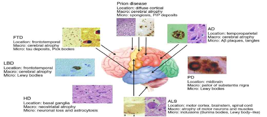 대표적인 퇴행성 뇌질환의 호발 부위 및 병리현상 신경 퇴화로 유도되는 다양한 퇴행성 뇌질환 중 파킨슨병 및 알츠하이머병은 현대 초고령화 시대의 대표적인 노인성 뇌질환으로 인식됨. AD, Alzheimer′s disease; PD, Parkinson′s disease; ALS, Amyotrophic lateral sclerosis; HD, Huntington′s disease; LBD, Lewy body disorder; FTD, Frontotemporal lobar degeneration. (Bertram and Tanzi, 2005 J. CIin. Invest.)