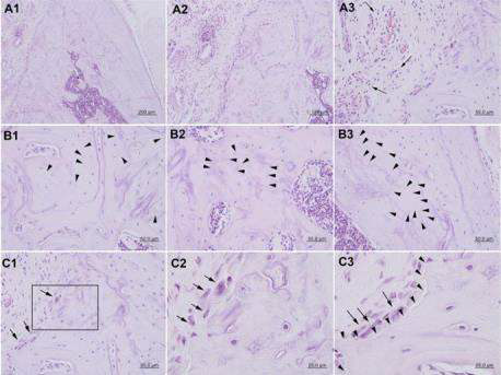 Histological findings with 20 Gy irradiation. The histological features with 20 Gy irradiation showed the presence of resorption line (A1, A2) with osteoclast cells (C1, C2, C3; arrow), inflammatory infiltrate (A3) and empty osteocytic lacunae (B1, B2, B3; arrow head). A1, A2: resorption line; A3 arrow: inflammatory cell; B1, B2, B3 arrow head: empty osteocytic lacunae; C1, C2, C3 arrow: osteoclast cells; C3 arrow head: dead bone border line