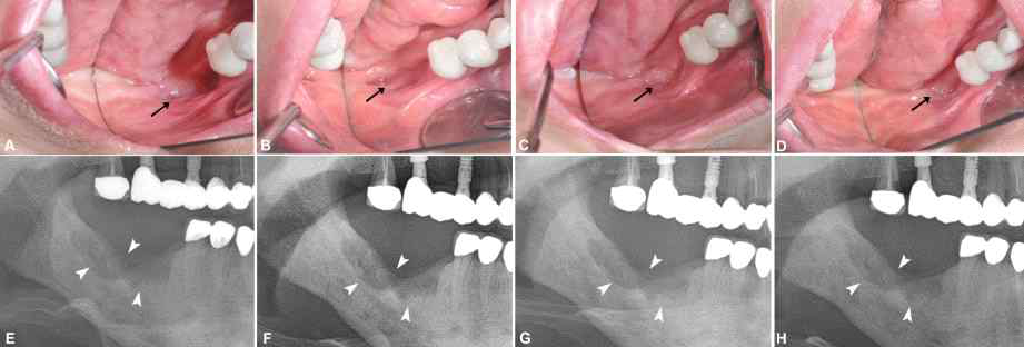 Serial occlusal clinical photos and panoramic views after using PTX and tocopherol in the Case No. 2 patient who had not undergone any surgery and had taken medication for ORN for 315 days, A,E; Before prescription, B, F; Three months after drug administration, C, G; Six months after drug administration, D, H; One year after drug administration