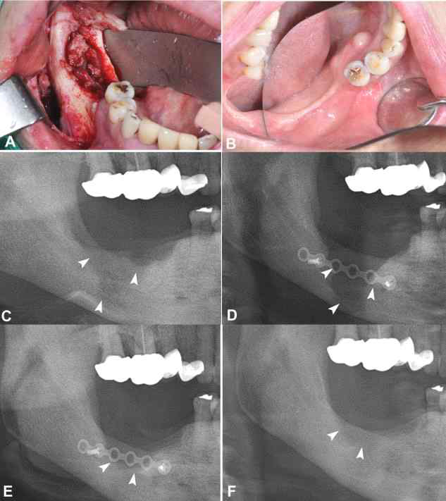 Serial radiographic changes with clinical photos after using PTX and tocopherol in the Case No. 10 patient who began PTX and tocopherol after surgical wound healing for treatment of BRONJ for 8 months, A. Clinical picture showing the pathologic lesion before surgery, B. One year after surgery and drug administration, C. Preoperative panorama showing the lesion extending to the mandibular border, D, One week after surgery, at the beginning treatment of PTX and tocopherol, E; Six months after drug administration, F; One year after drug administration