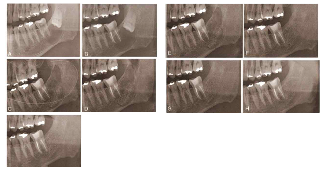 Panoramic views of the bony regeneration process in group 2, preoperative (A), endodontic treatment of involved molar (B), postoperative day 1 (C), 1 month (D) 3 months (E), 6 months (F), 12 months (G), 2 years (H), and 3 years (I)