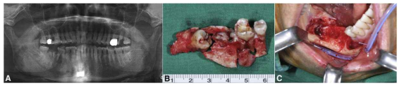 Clinical and radiological findings of case number 16, showing a preoperative panoramic view (A), surgical specimens (B), and the intraoral wound with drain insertion (C)