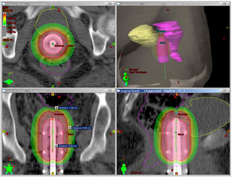 실린더 어플리케이터를 이용한 질내 근접치료 시 등선량 분포 (방광의 후벽과 직장의 전벽이 치료범위에 포함됨)