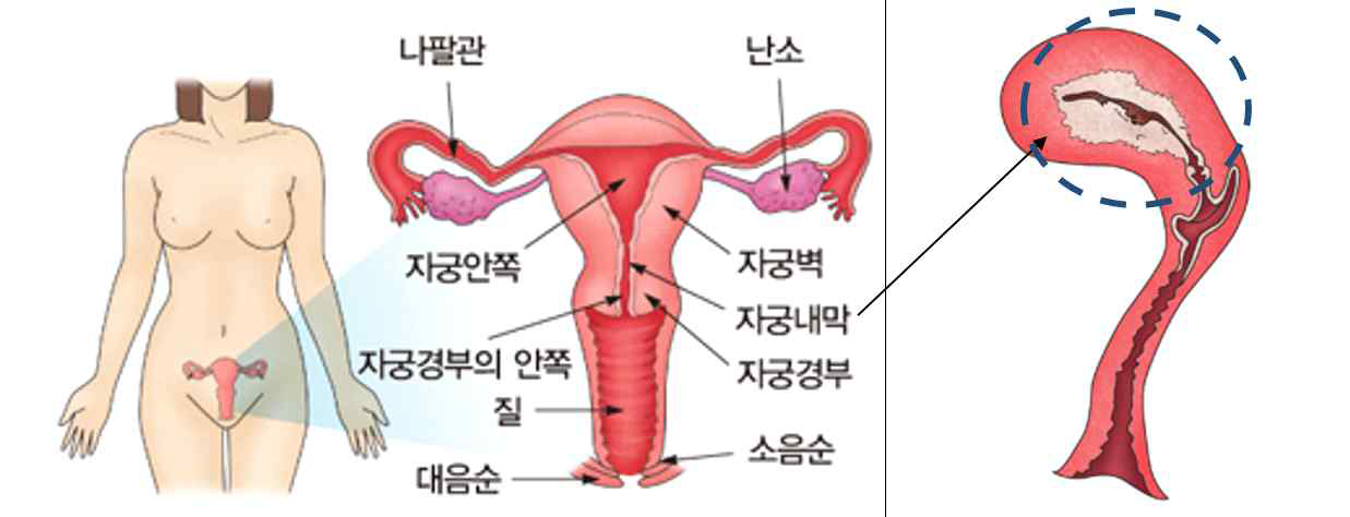 자궁의 전면부와 측면부 및 자궁내막암의 발생 위치