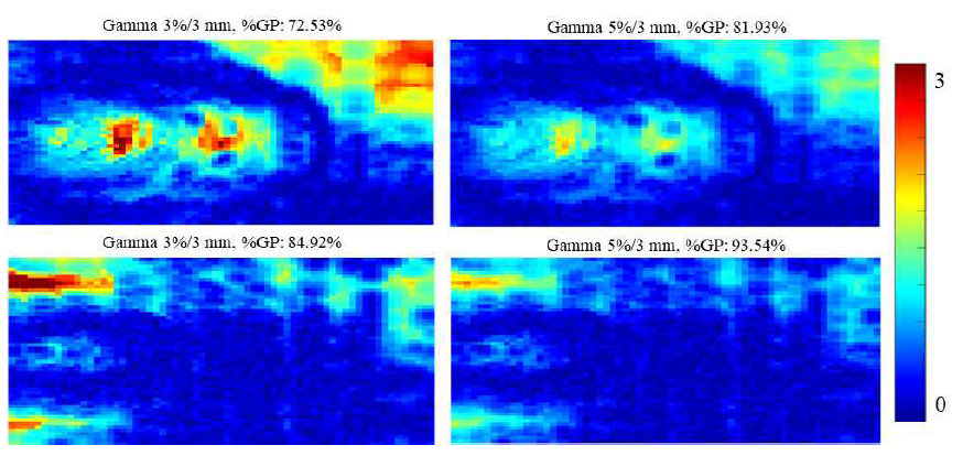 인체모사 팬톰 (3 cm applicator)에서 직장 내 roll-up 기법을 활용한 직장 내벽 선량 측정 결과와 프로그램을 활용한 계산 결과의 gamma evaluation distribution; 위) 3 cm applicator 인체모사 팬톰, 아래) 4 cm applicator 인체모사 팬톰