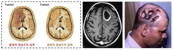 뇌종양의 종류 및 MRI 사진과 종양 제거 후 양상 (Central illinois neuro health sciences 그림 참조)