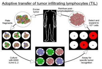 종양침윤림프구를 이용한 세포치료