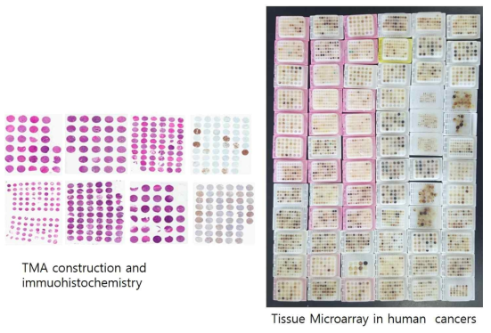 소화기암의 Tissue Microarray 구축