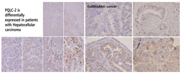 소화기암중 Hepatocellular carcinoma 에서 Gpr-A의 차등발현 양상관찰