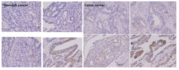 소화기암중 위암, 대장암에서 Gpr-A의 차등발현 양상관찰