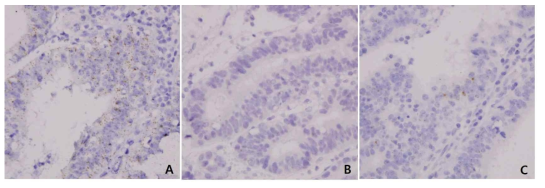 RNA in situ hybridization of Gpr-A in colon cancer. A) positive control, B) negative control, C) colon cancer case