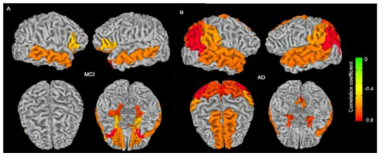 경도인지장애 (A)에서 알츠하이머병 (B)으로 진행할수록 대뇌 피질의 위축과 양의 상관관계를 보이는 타우 병리 침착의 정도가 증가함을 확인함