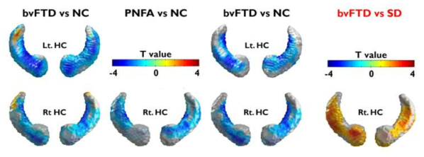 Vertex 기반 MRI 정량 분석을 통해 전두측두치매환자에서 보이는 해마의 위축 정도를 비교함. 상기 변화는 알츠하이머병에서 대표적으로 나타나는 변화이나 전두측두치매에서 나타나는 차이를 본 연구진이 확인한 바 있음. 이는 알츠하이머병과 전두측두치매 비교의 중요한 reference가 될 수 있음