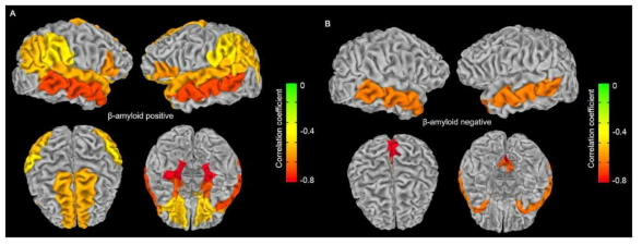 아밀로이드 양성인 대상자 (A)에서 음성인 대상자 (B) 보다 대뇌 위축과 Tau-PET의 침착 정도가 더 높은 상관성을 보였고, 특히 해마에서는 아밀로이드 양성인 대상자에서만 대뇌 위축과 Tau-PET 침착 간 상관관계를 보임