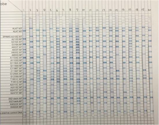 An example of REBA result performed with the DNA sample from atopic dermatitis patients and healthy controls