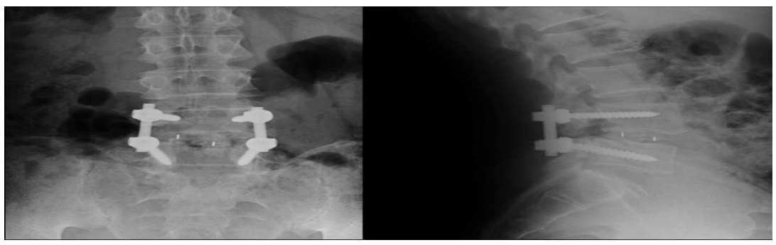 척추전방전위증(Spondylolisthesis) 환자의 척추에 유합술을 시행한 모습