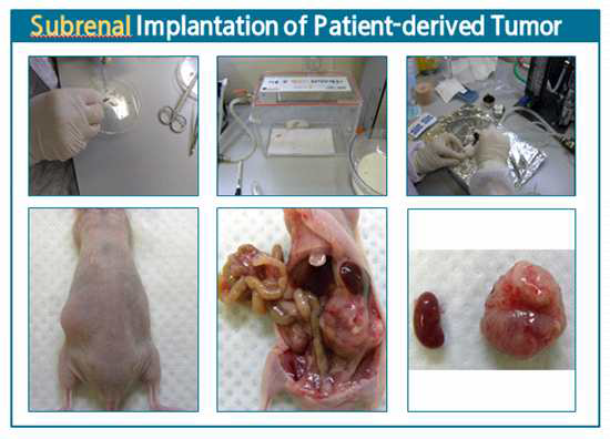 난소암 PDX 모델 구축을 위한 subrenal capsule에 환자 조직을 이식하는 과정