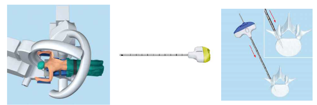 (좌) 실시간 영상촬영기 (C-arm)를 이용하여 세포 이식 (중앙) Vertebroplasty needle (우) vertebroplasty needle을 척추에 삽입하는 장면
