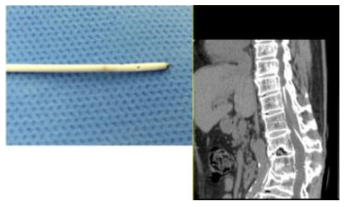 catheter tip occlusion (#case 1)