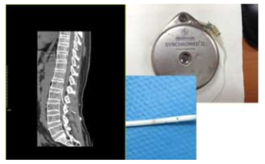 catheter tip occlusion (#case 2)