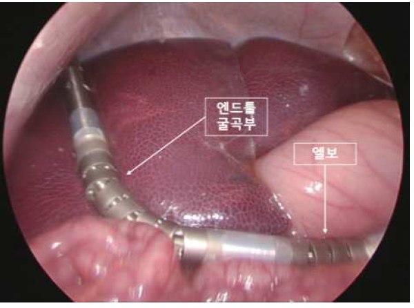 복강경을 통해 보이는 다관절형 무혈절제기의 엔드툴 굴곡부와 엘보