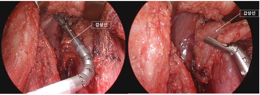 다관절혈 레이저 무혈절제기를 이용한 갑상선 절제 사진. 엔드툴의 굴곡을 통한 협소한 공간에서도 용이하게 혈관의 절제가 가능