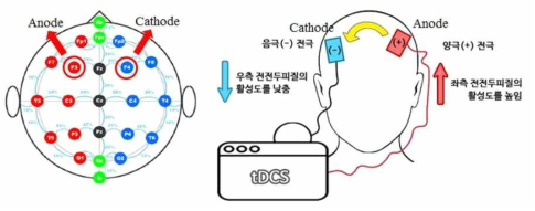 tDCS의 우울증 프로토콜