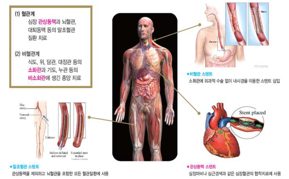 스텐트 정의 및 분류