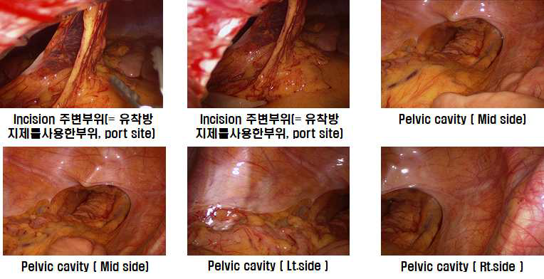 수술부위와 주변조직의 유착방지 효과 및 안전성 평가(대조군)