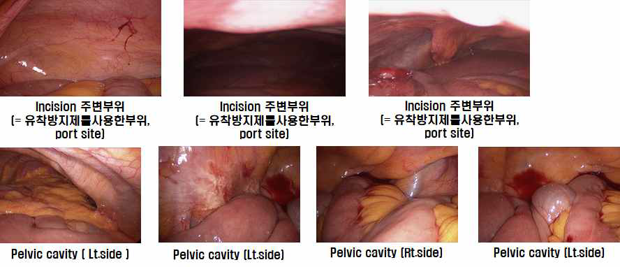 수술부위와 주변조직의 유착방지 효과 및 안전성 평가(시험군-1)