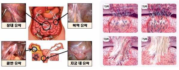 복강 내 유착부위 및 조직유착과정