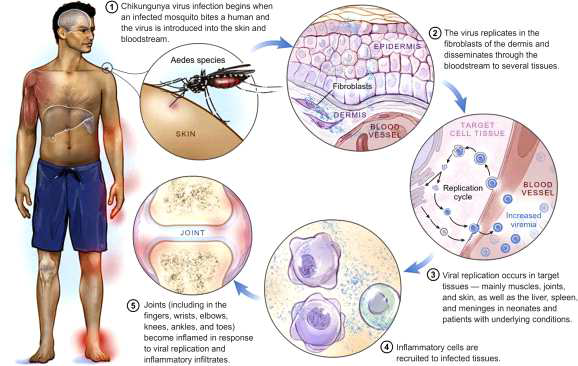 치쿤구니야 바이러스 감염의 Pathogenesis (Antiviral Res. 2015; 121: 120-31. Couderc T, et al.)