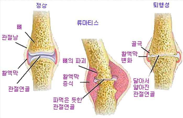 골 관절염과 류마티스 관절염의 원인