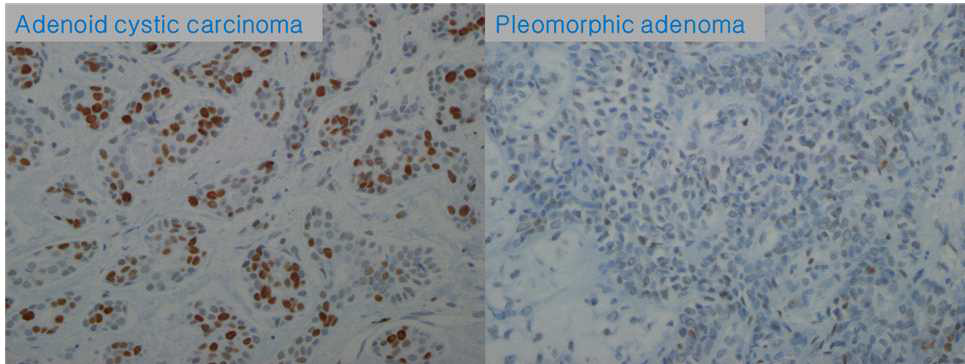 MCM2 L.I: Adenoid cystic carcinoma and pleomorphic adenoma (x400)