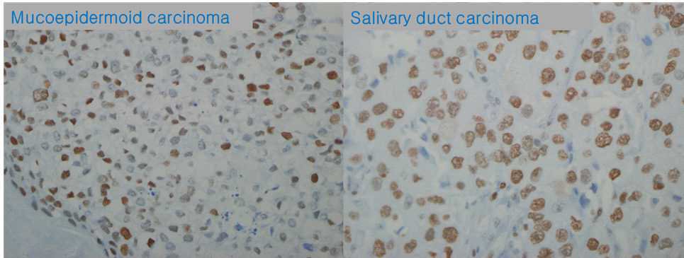 MCM2 L.I: Mucoepidermoid carcinoma and salivary duct carcinoma (x400)