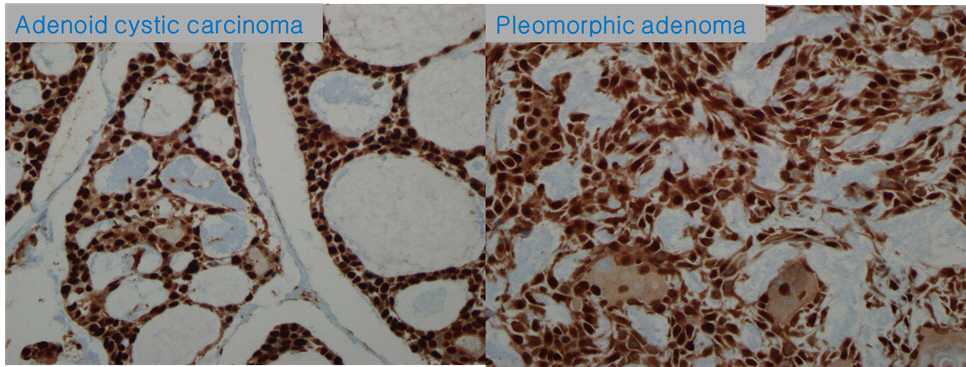 MCM3 L.I: Adenoid cystic carcinoma and pleomorphic adenoma (x400)