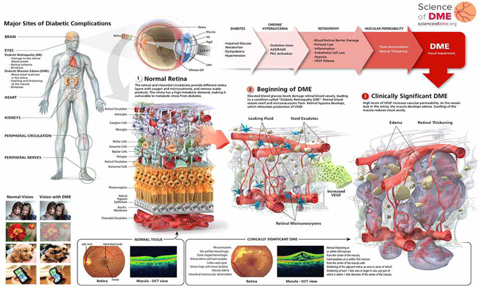 당뇨병성 황반부종의 개요(Source: www.scienceofdme.org)