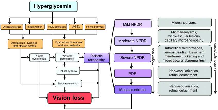 당뇨병성 망막병증의 병태생리 및 분류 (출처: UpToDate, 2015)