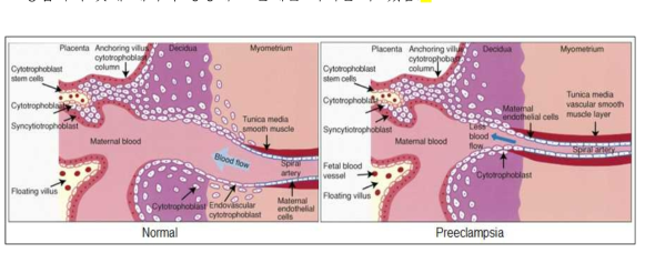 임신중독증 태반에서의 비정상적 태반형성 문제