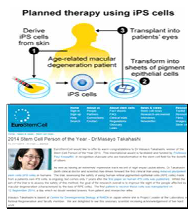 Takahashi 박사팀이 주도한 유도만능줄기세포 임상연구