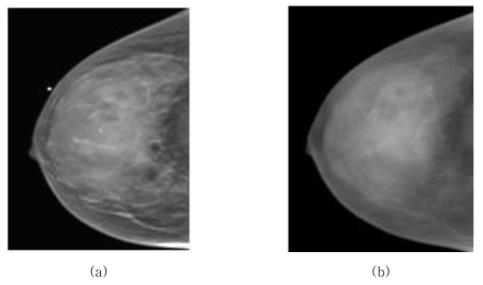 유방암 조기진단장치 이용 치밀유방에서의 중첩된 촬영 이미지 (a) Mammography (b) Digital Breast Tomosynthesis (DBT)